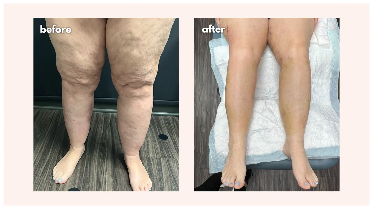 Lipedema before-and-after comparison.