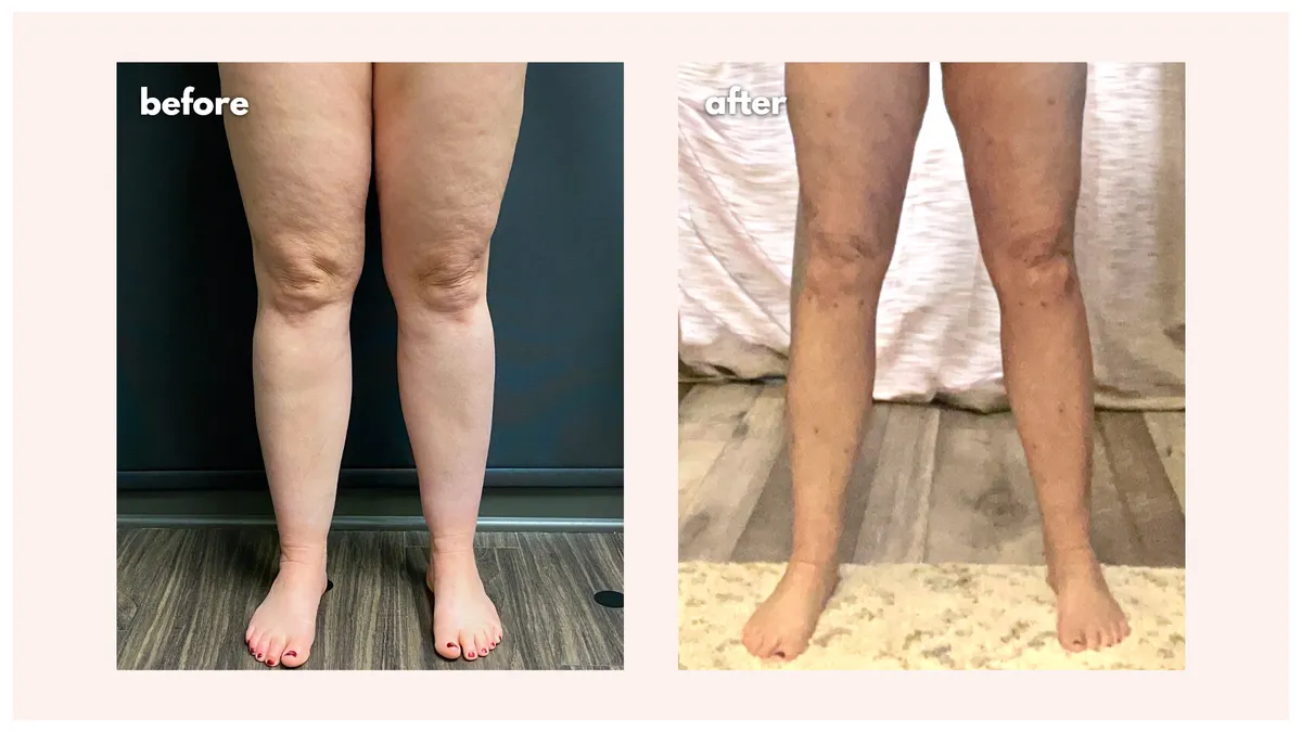 Lipedema before-and-after comparison.