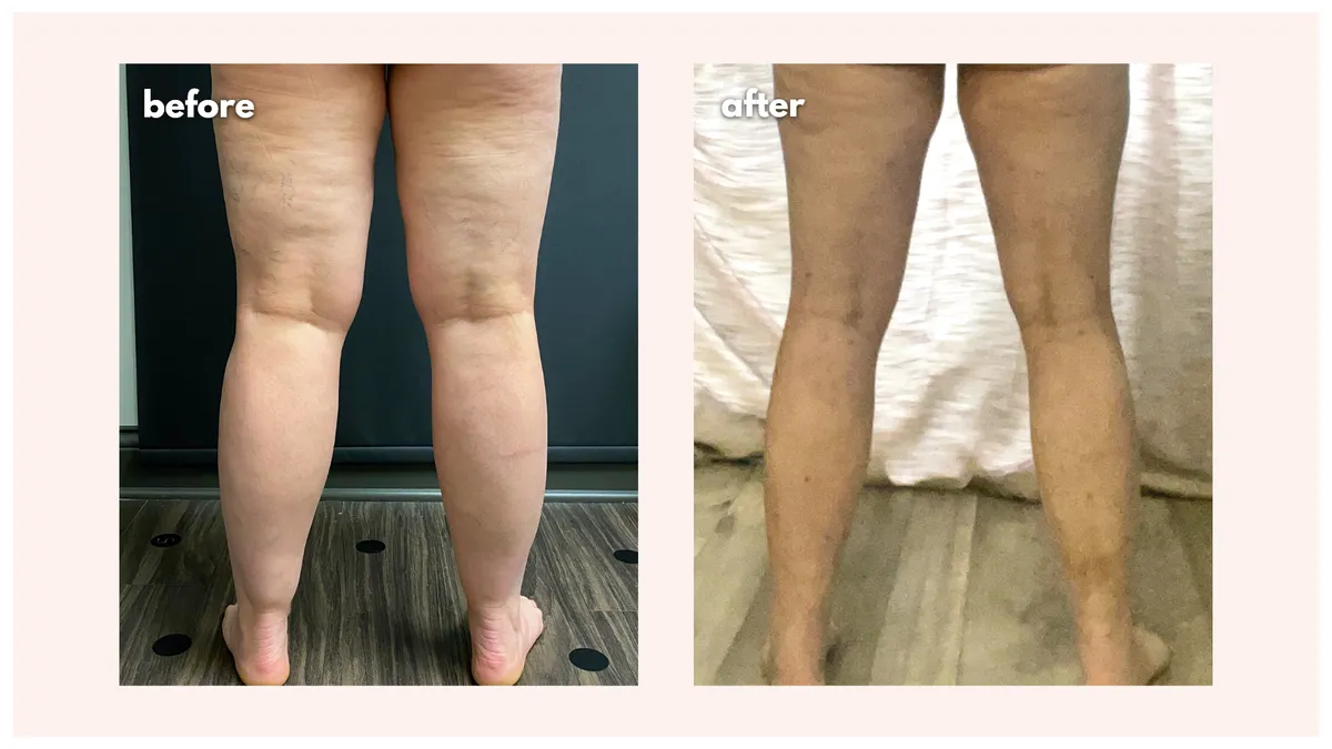 Lipedema before-and-after comparison.