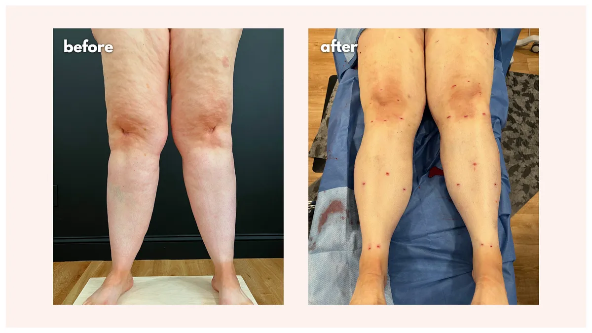 Lipedema before-and-after comparison.