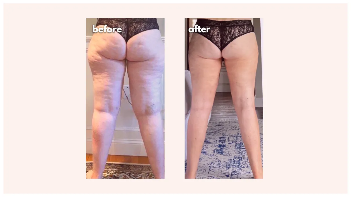 Lipedema before-and-after comparison.