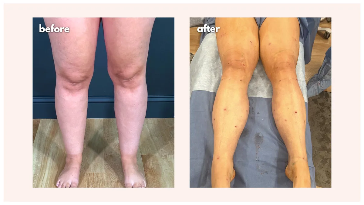 Lipedema before-and-after comparison.
