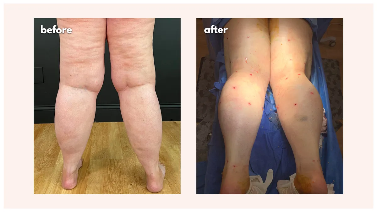 Lipedema before-and-after comparison.