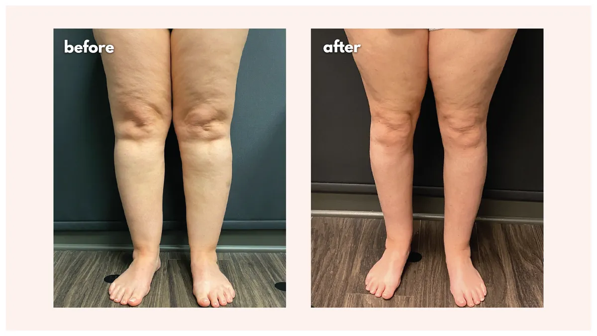 Lipedema before-and-after comparison.