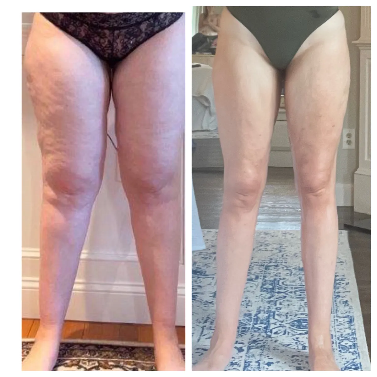 Lipedema before-and-after comparison.