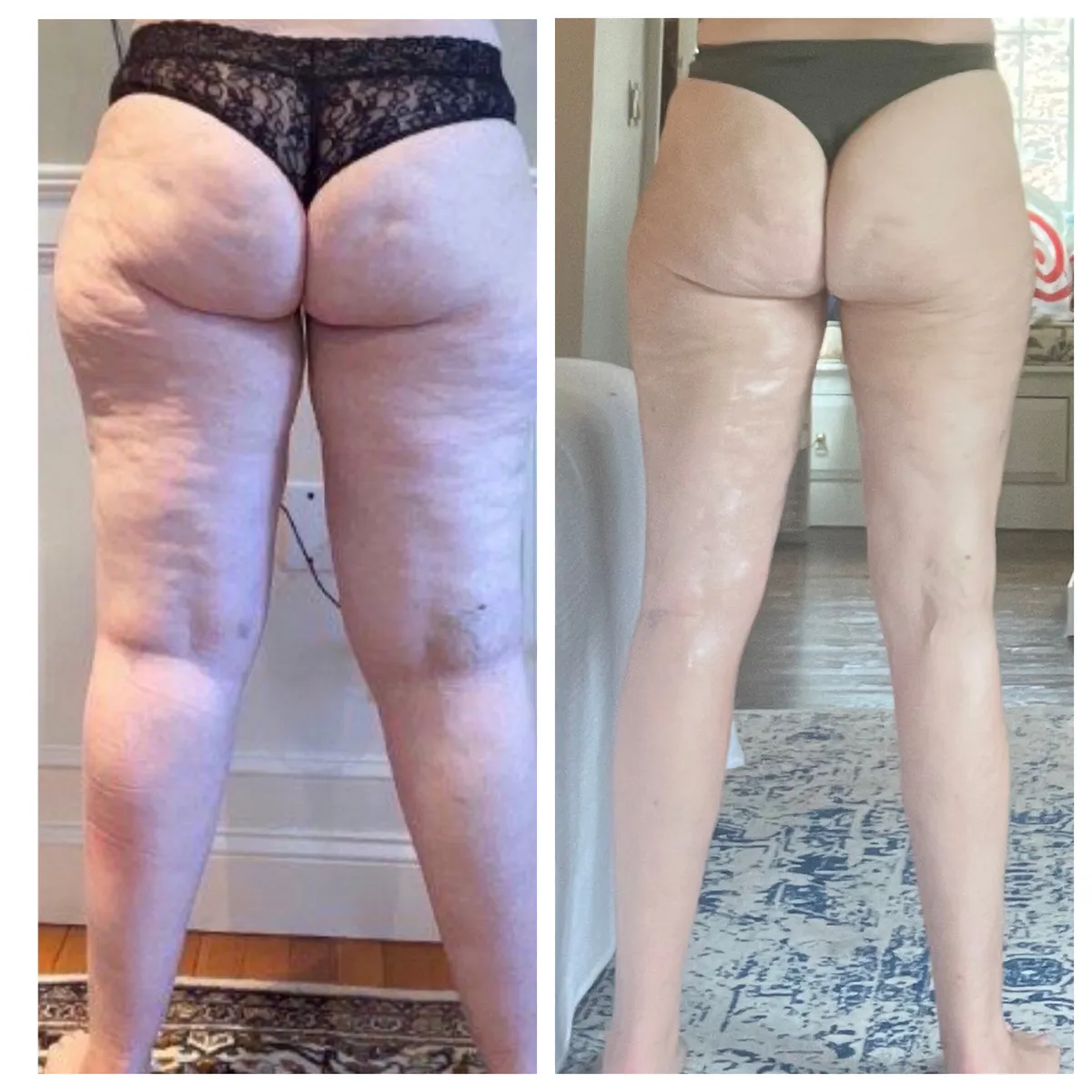 Lipedema before-and-after comparison.