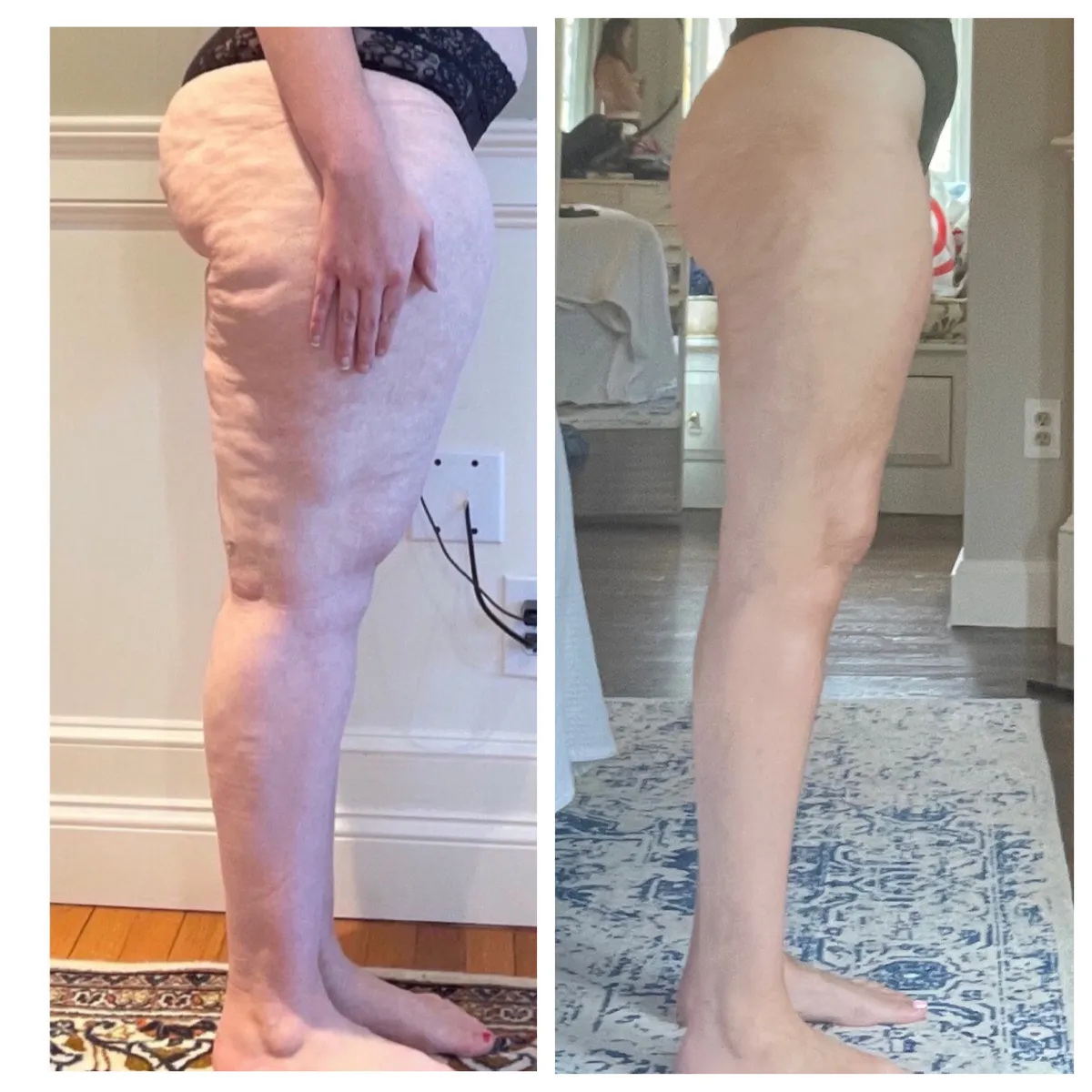 Lipedema before-and-after comparison.