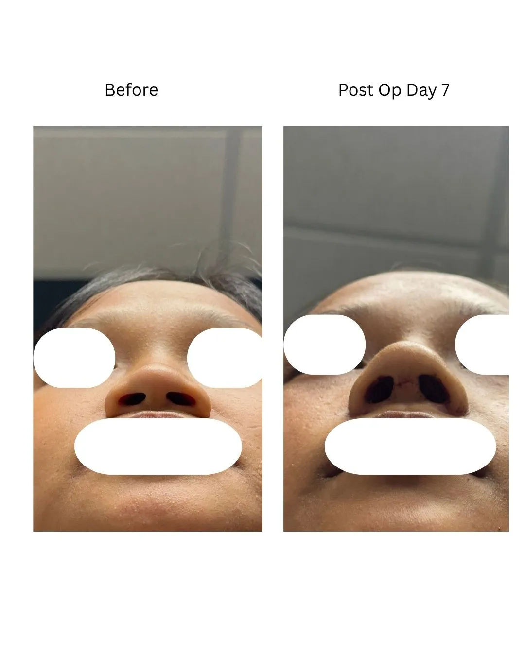 Rhinoplasty before-and-after bottom view, seven days after surgery.