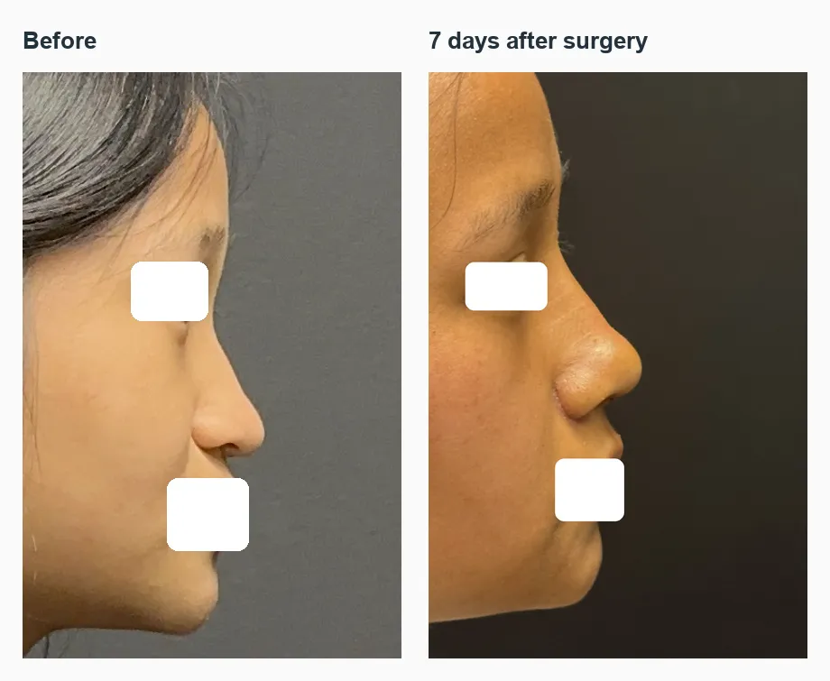 Rhinoplasty before-and-after right profile, seven days after surgery.
