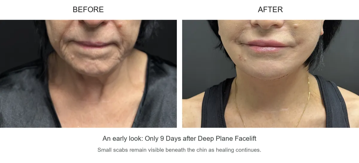 Facelift case 01: before-and-after comparison.