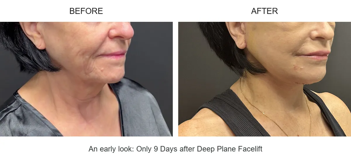 Facelift case 01: before-and-after comparison.