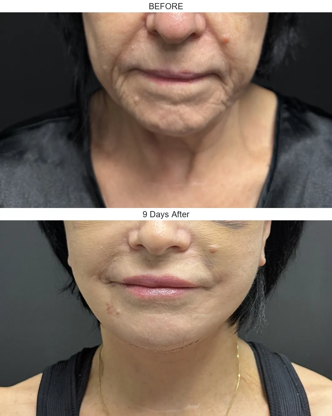 Facelift case 01: before-and-after comparison.