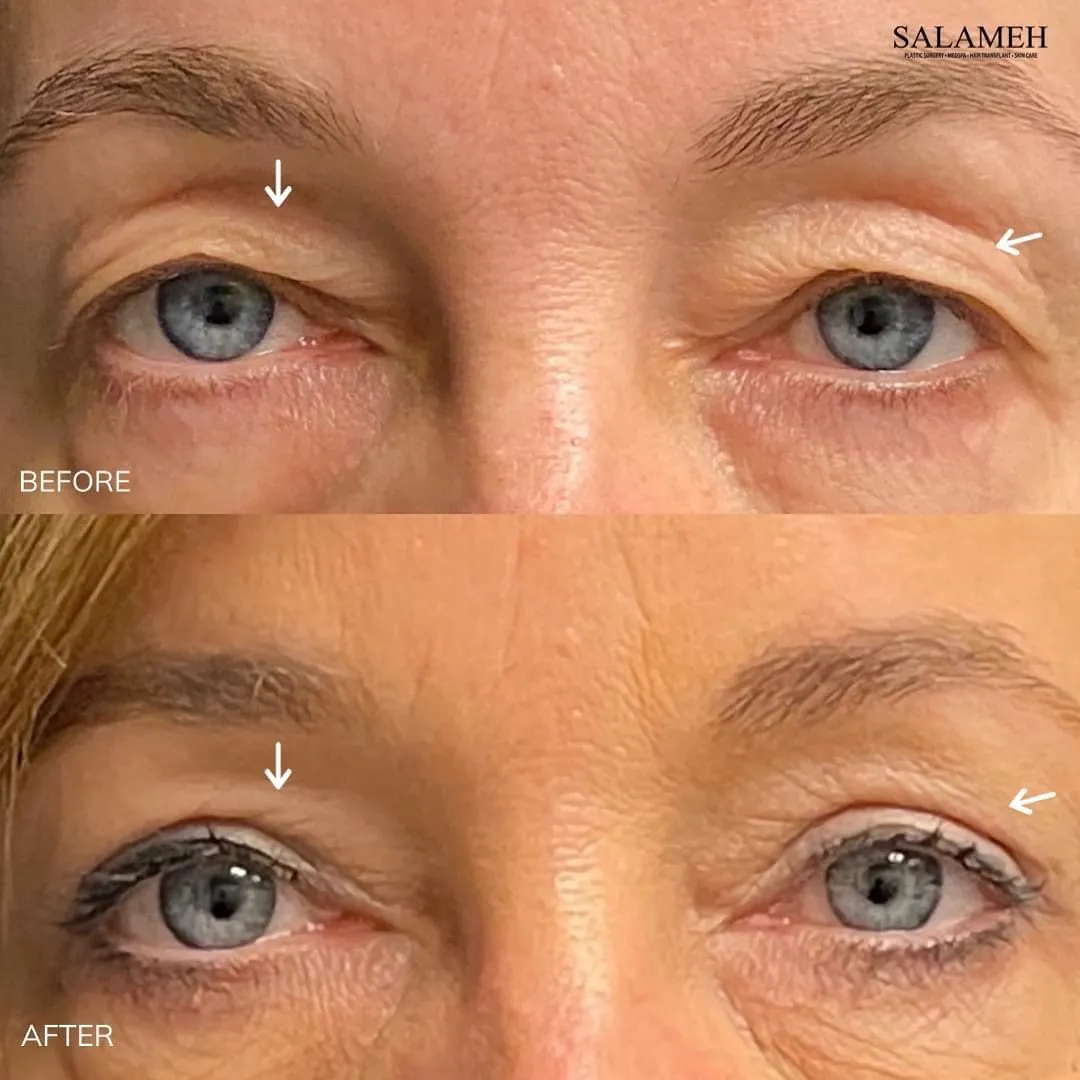 Before-and-after eye-area comparison
