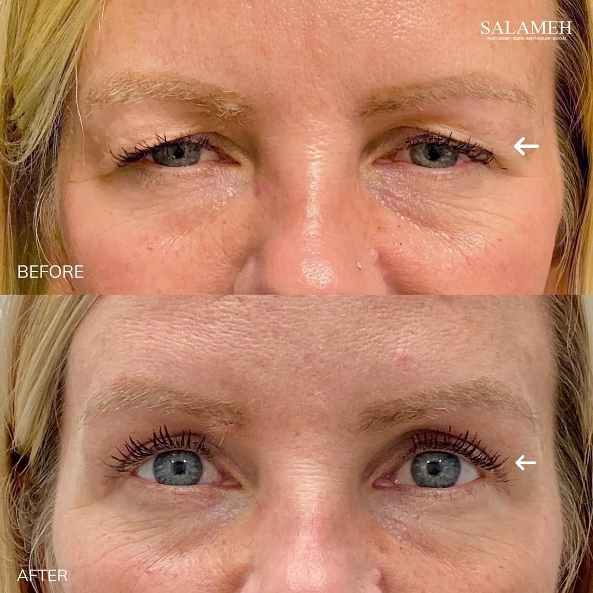 Before-and-after eye-area comparison