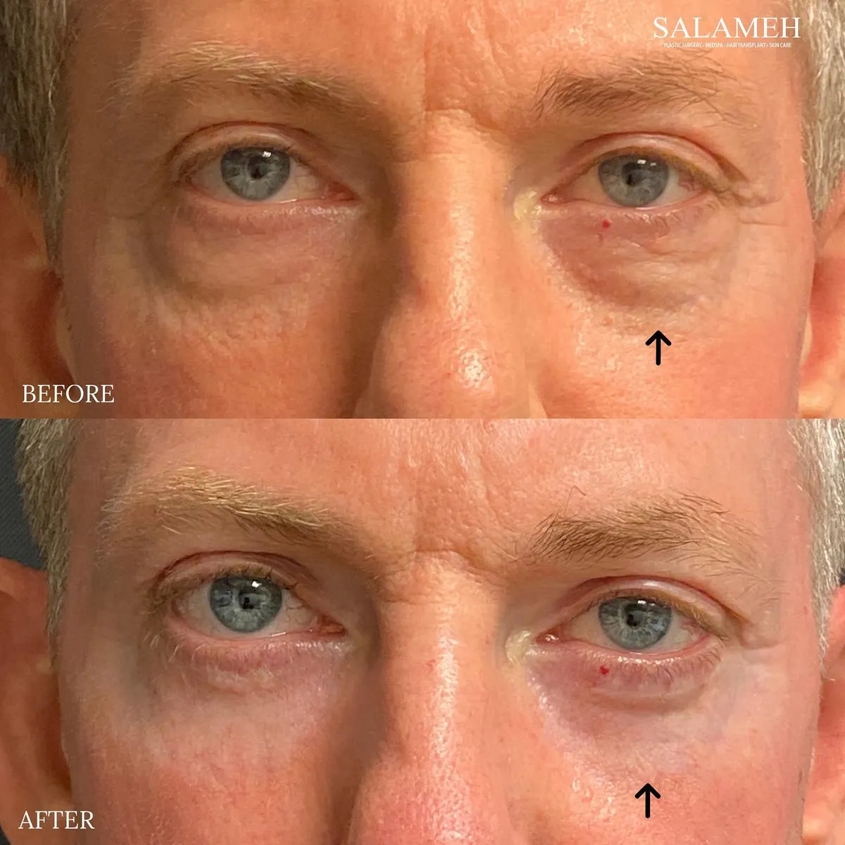 Before-and-after eye-area comparison