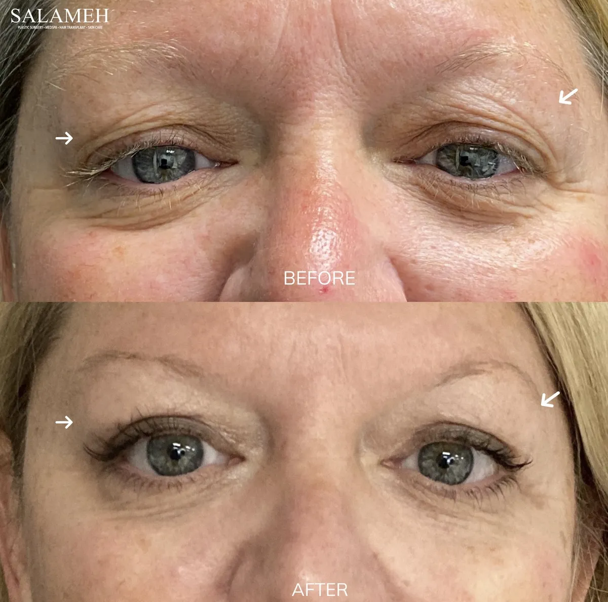 Before-and-after eye-area comparison