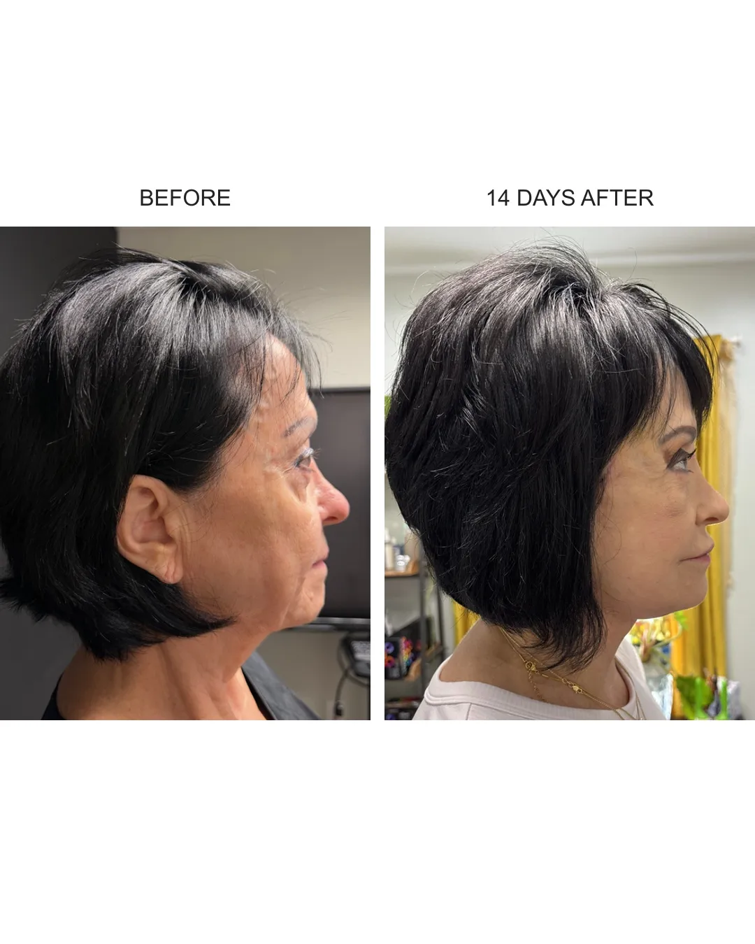 Facelift case 01: before-and-after comparison.