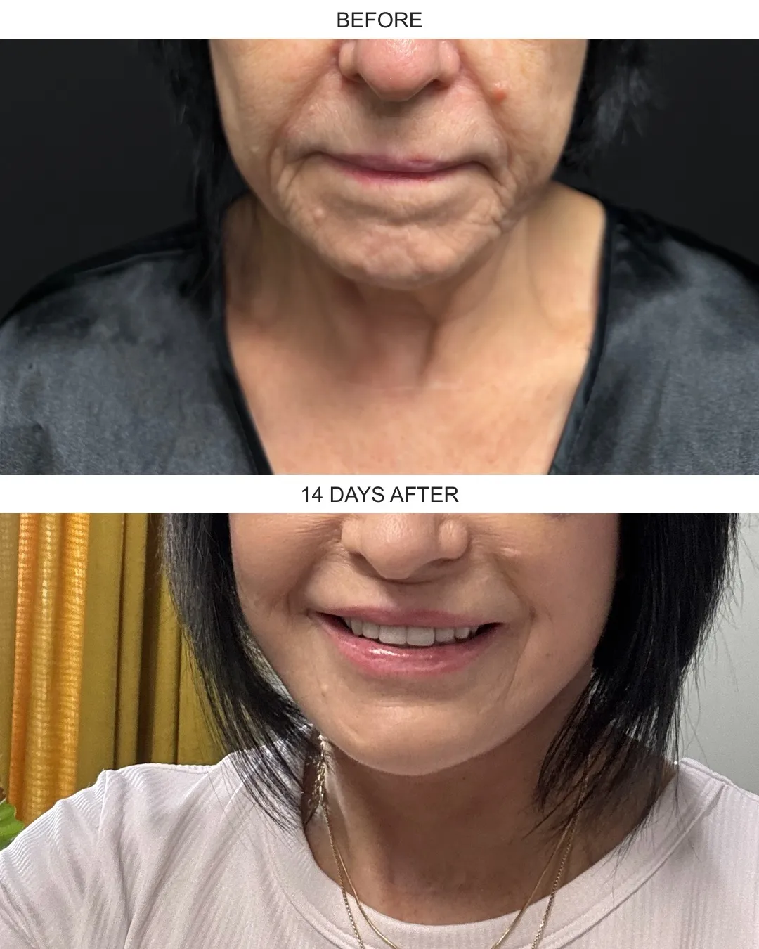 Facelift case 01: before-and-after comparison.