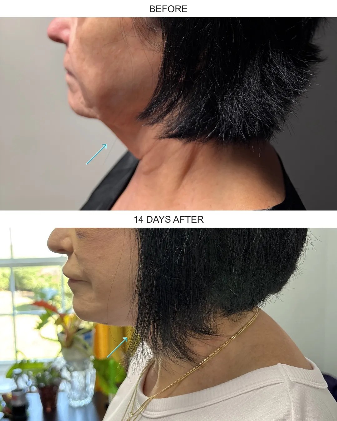 Facelift case 01: before-and-after comparison.