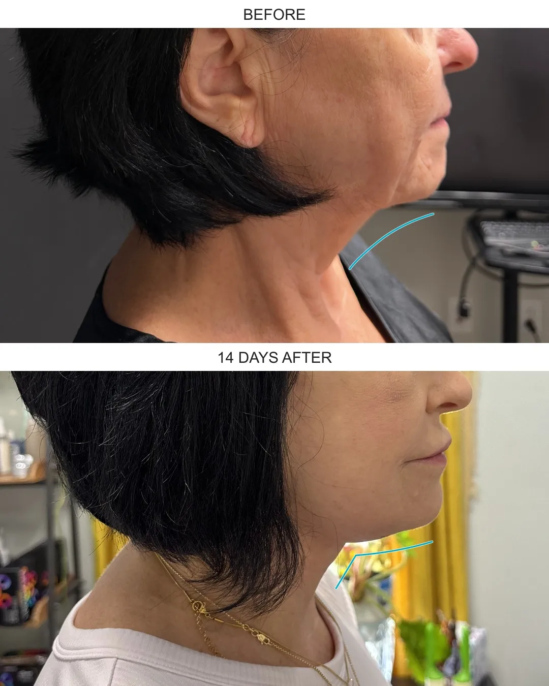 Facelift case 01: before-and-after comparison.