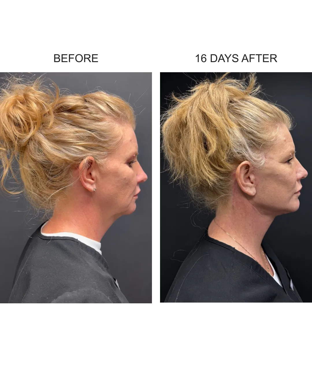 Facelift case 02: before-and-after comparison.