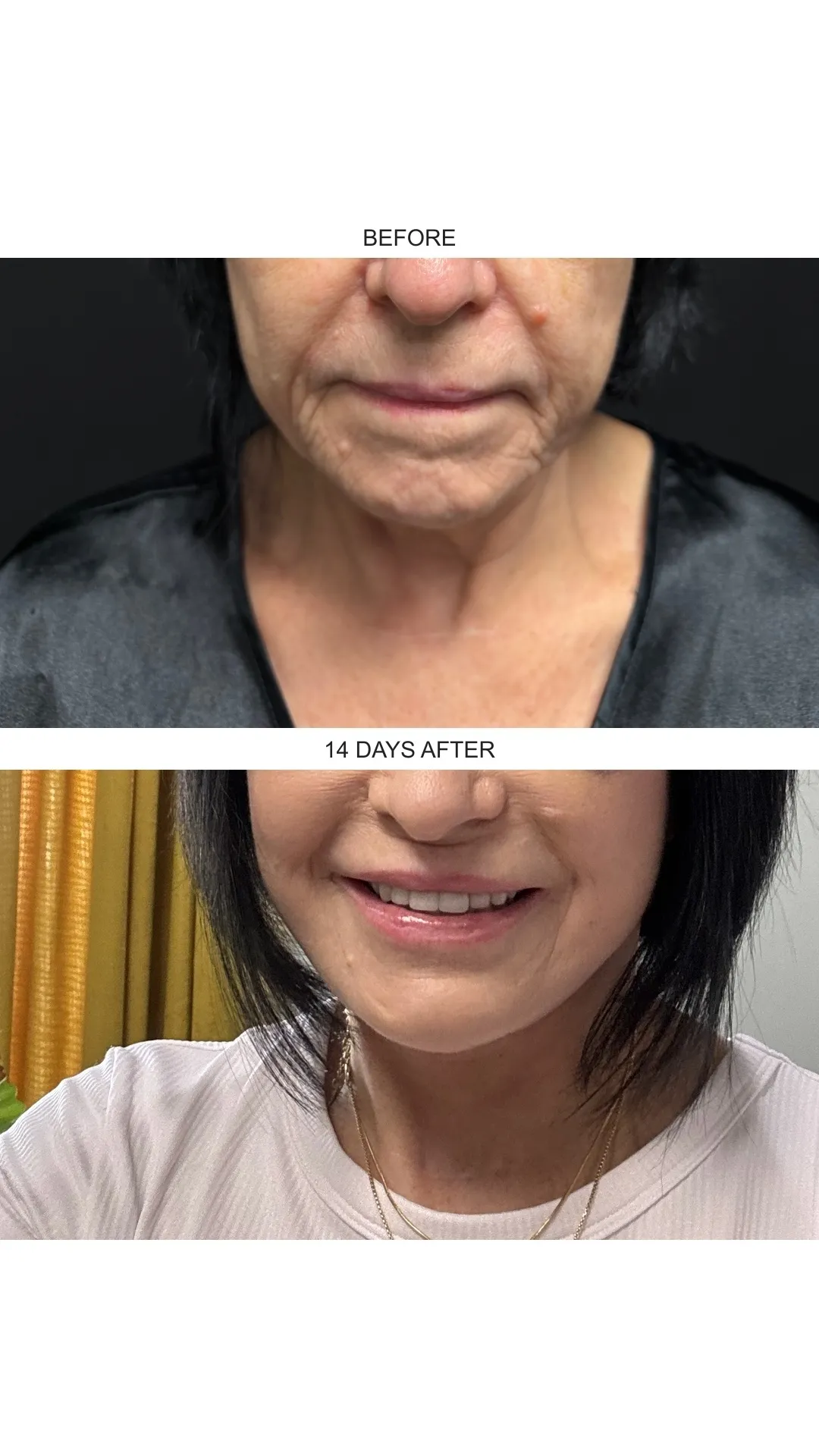 Facelift case 01: before-and-after comparison.