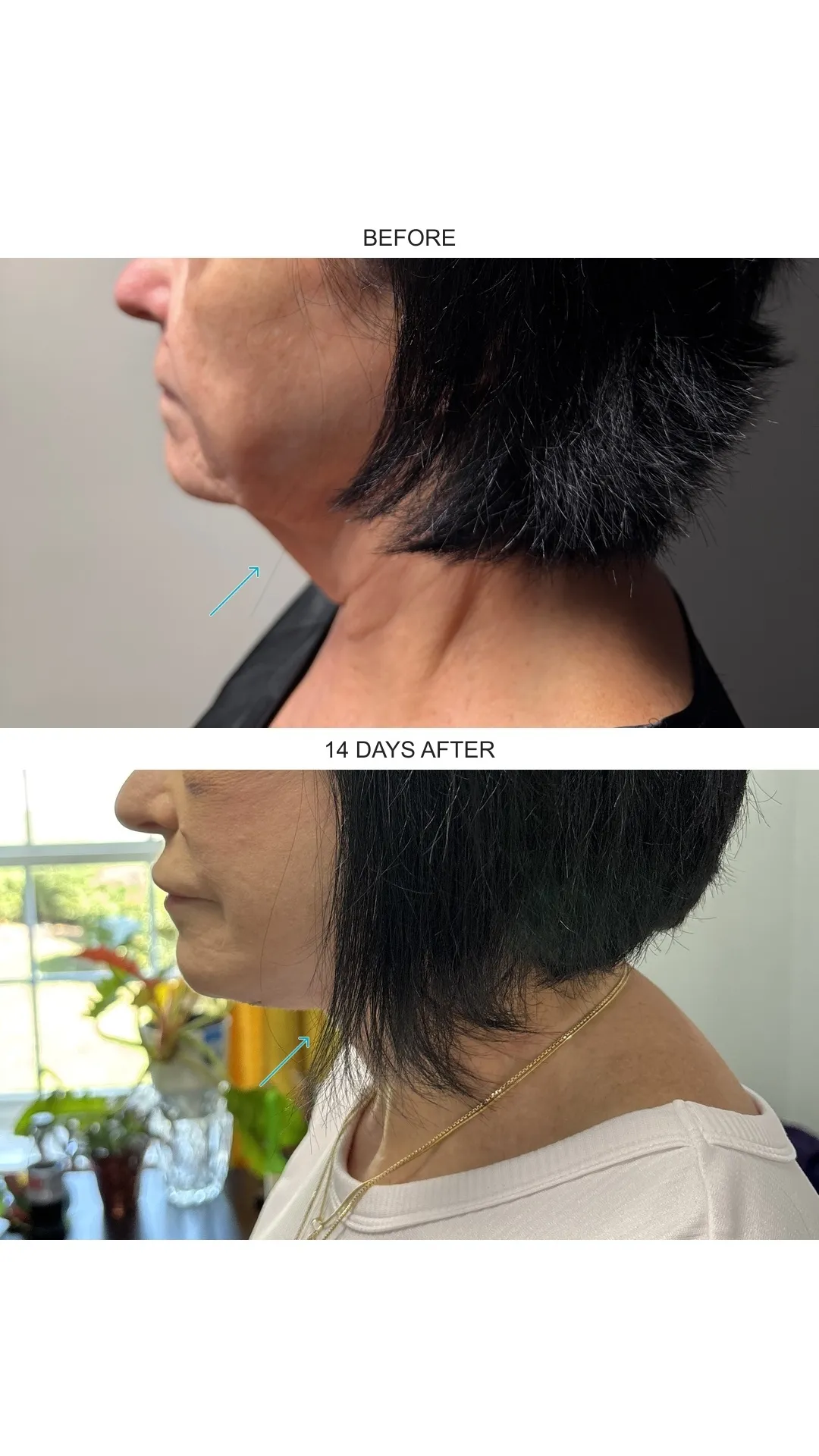 Facelift case 01: before-and-after comparison.