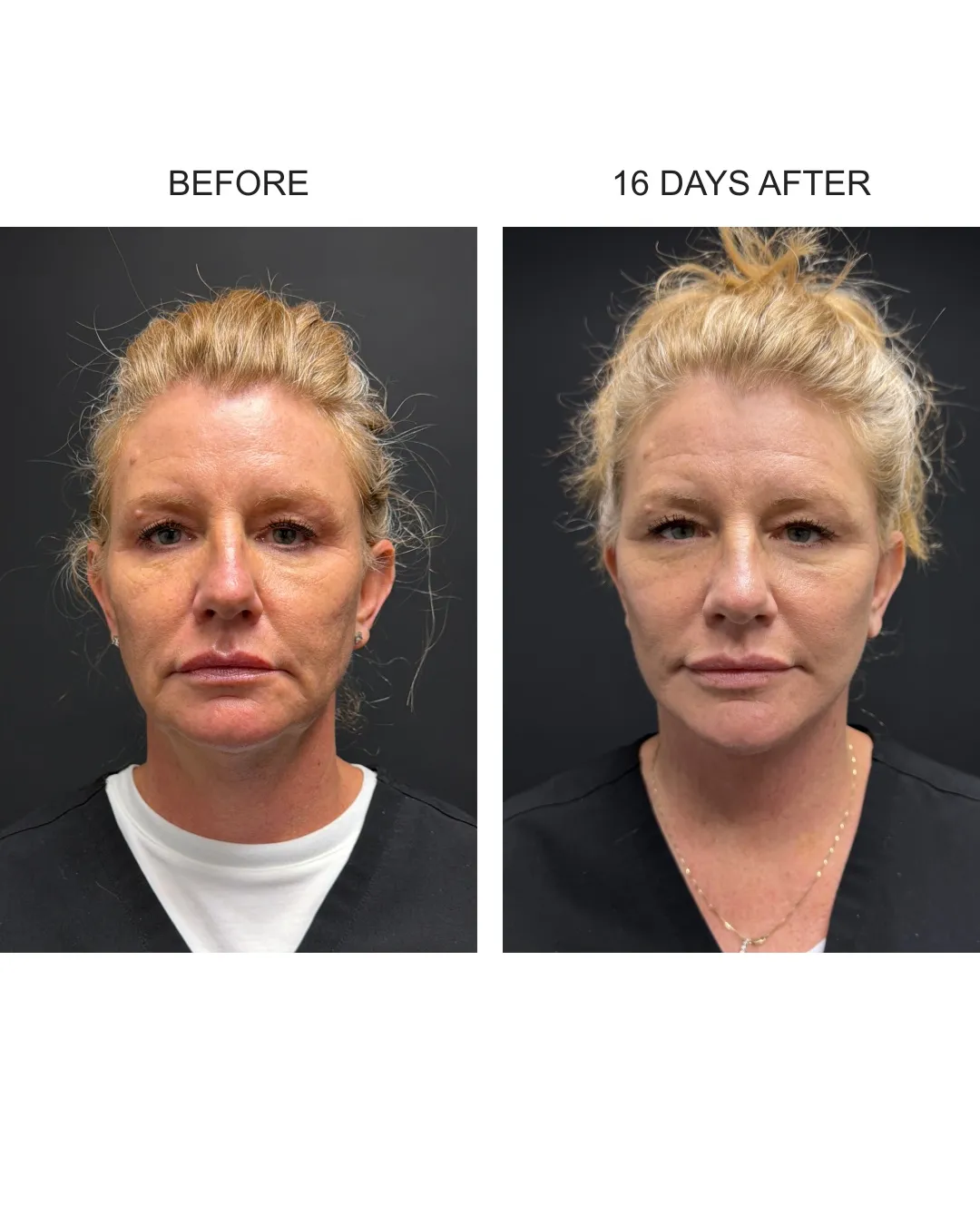 Facelift case 02: before-and-after comparison.