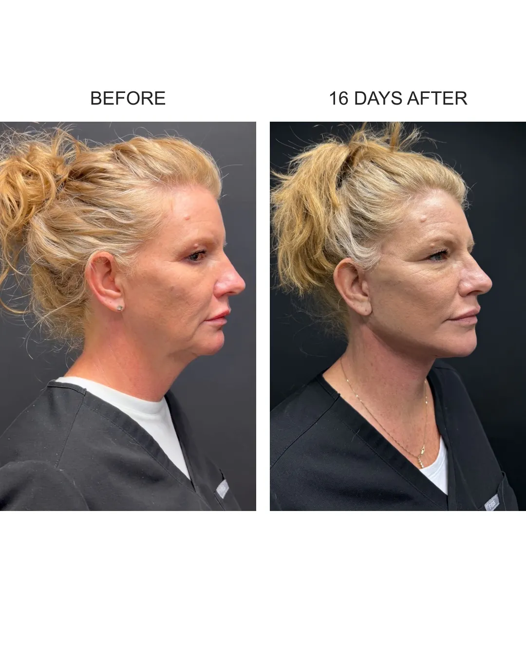 Facelift case 02: before-and-after comparison.