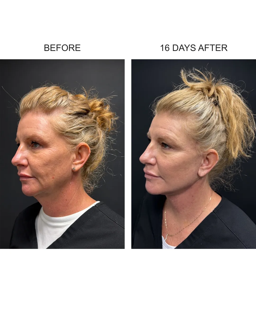 Facelift case 02: before-and-after comparison.