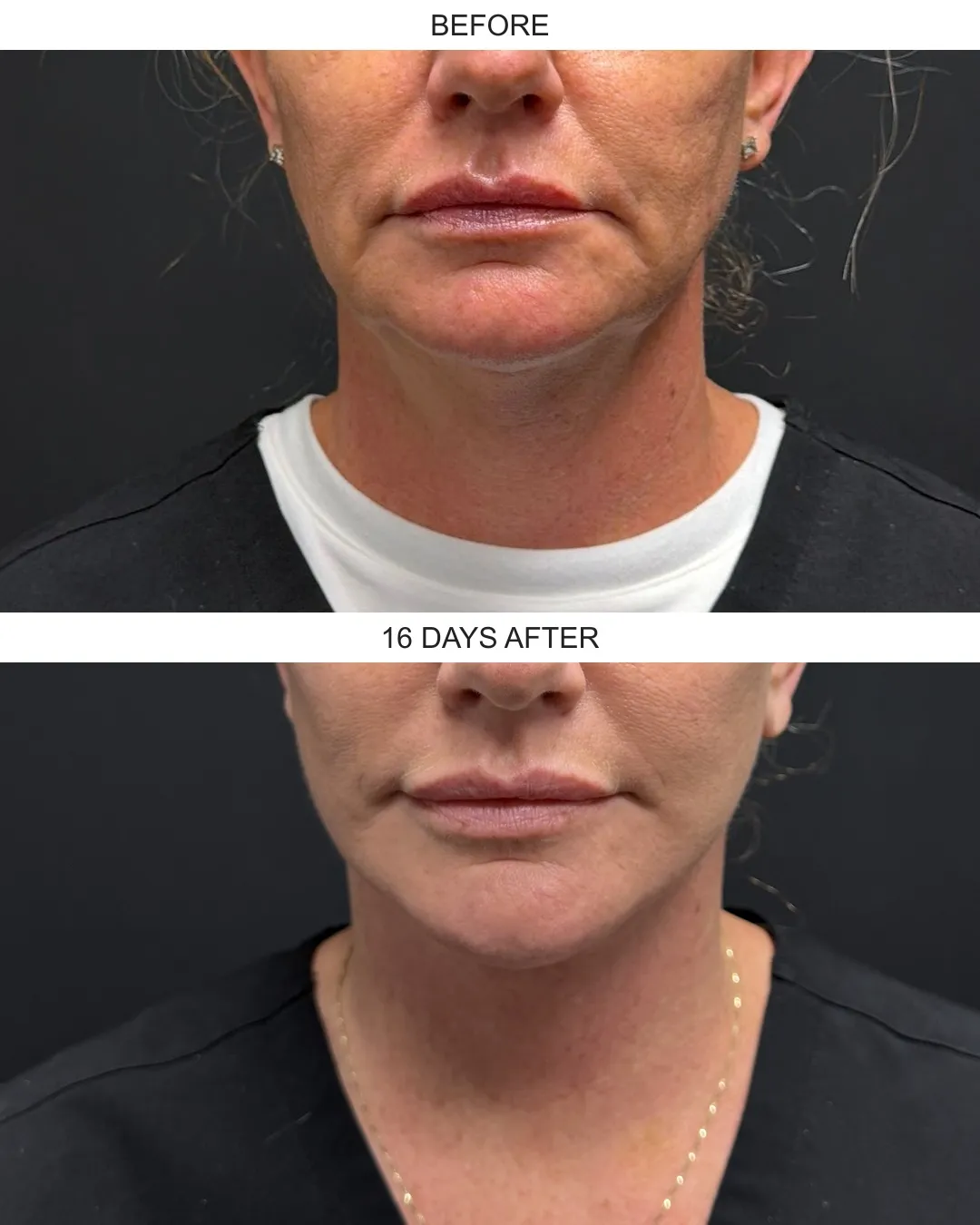 Facelift case 02: before-and-after comparison.