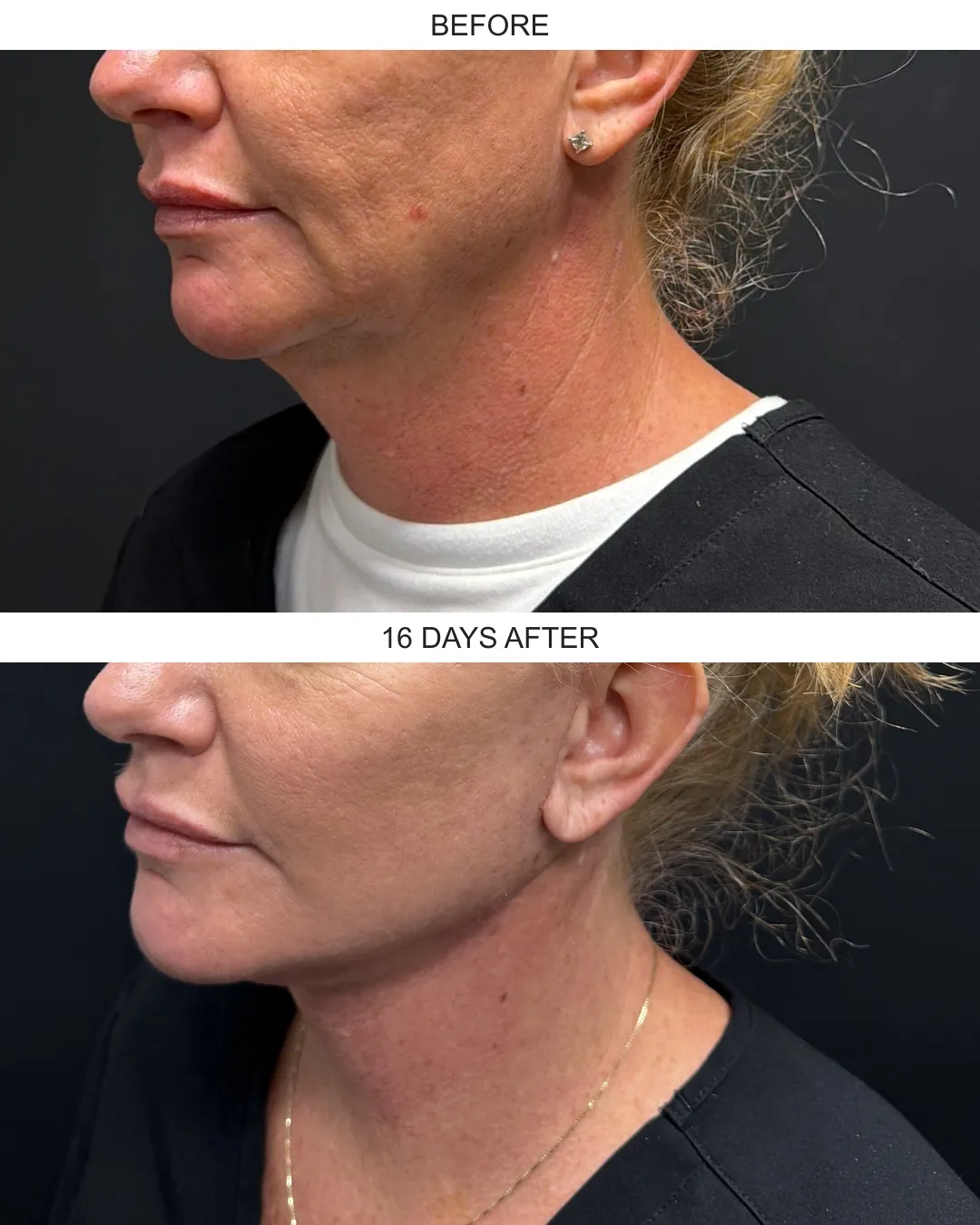 Facelift case 02: before-and-after comparison.