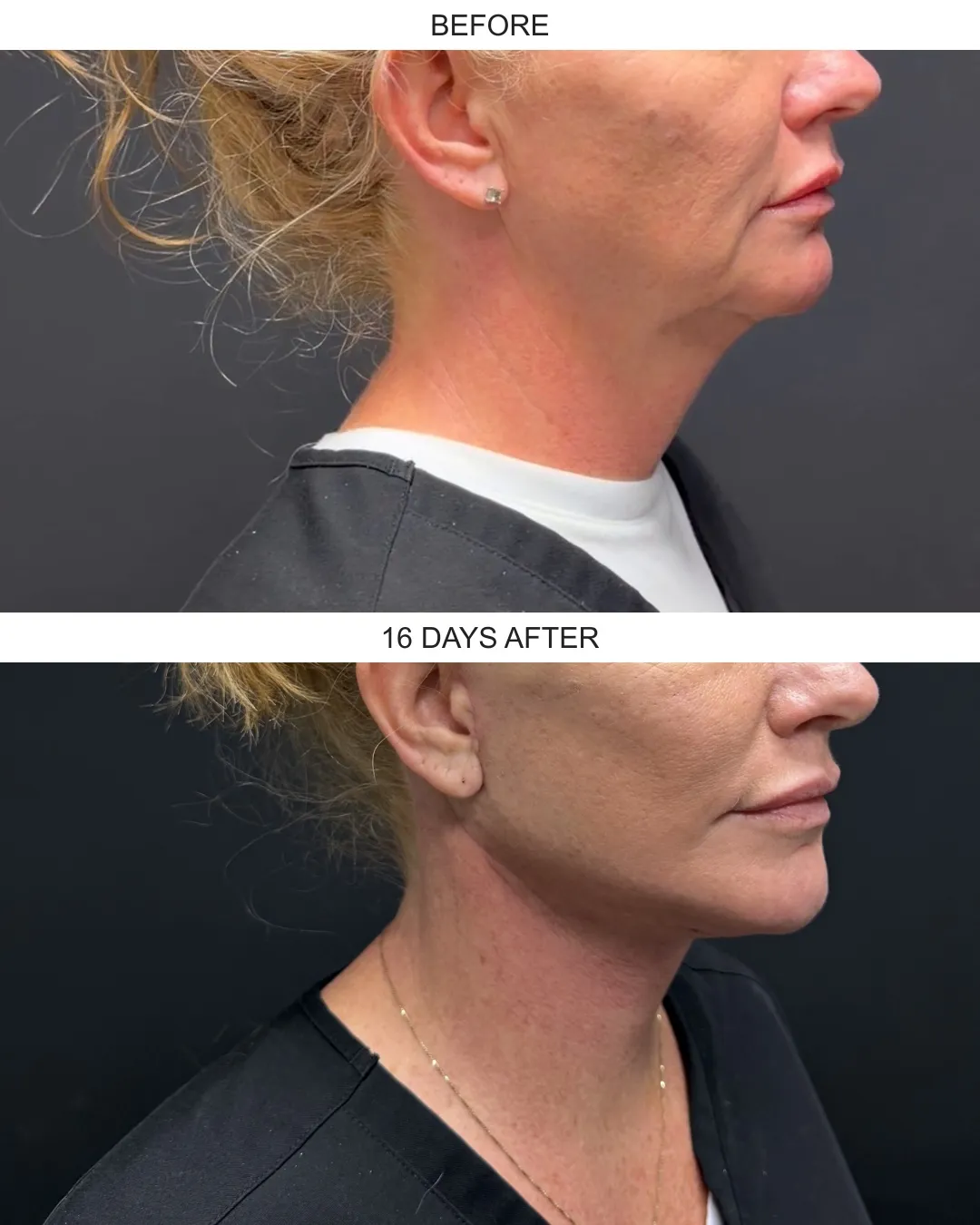 Facelift case 02: before-and-after comparison.