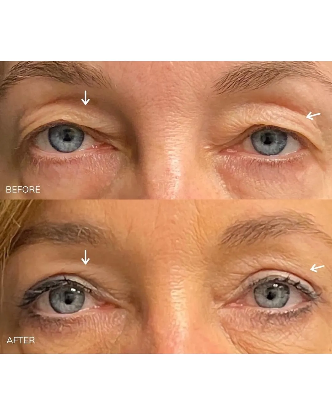 Before-and-after eye-area comparison