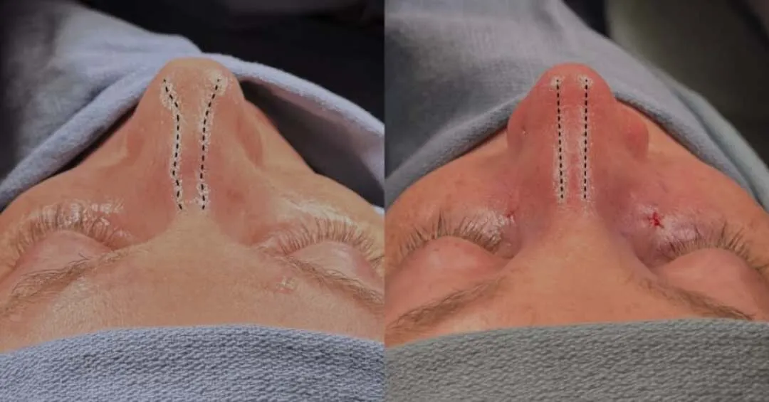 Rhinoplasty before-and-after comparison.