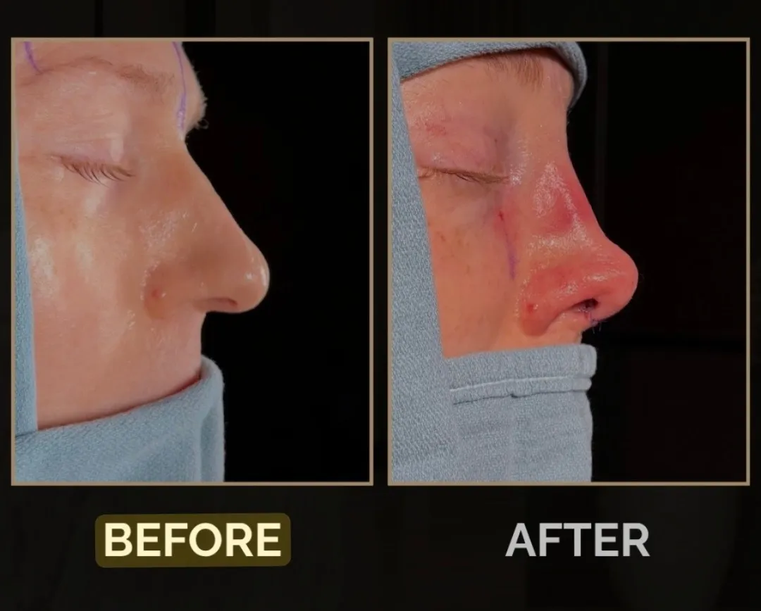 Rhinoplasty before-and-after comparison.