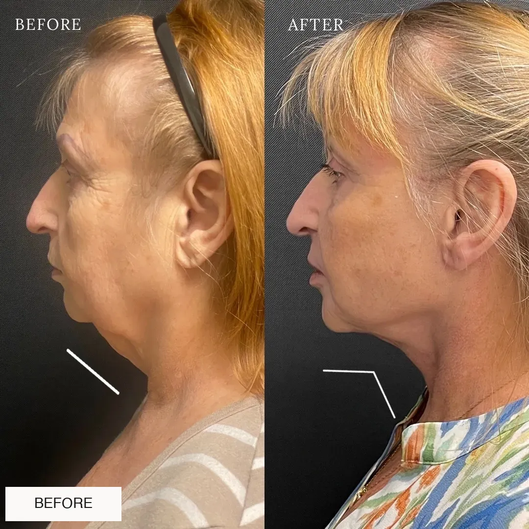 Facelift and neck lift before-and-after comparison.