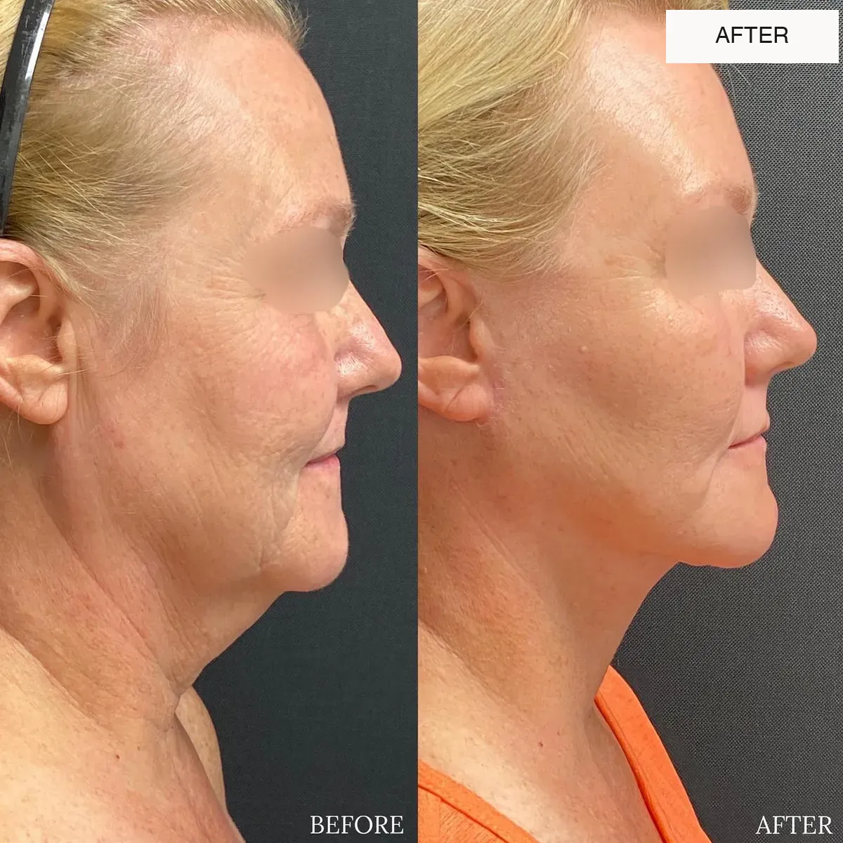 Facelift and neck lift before-and-after comparison.