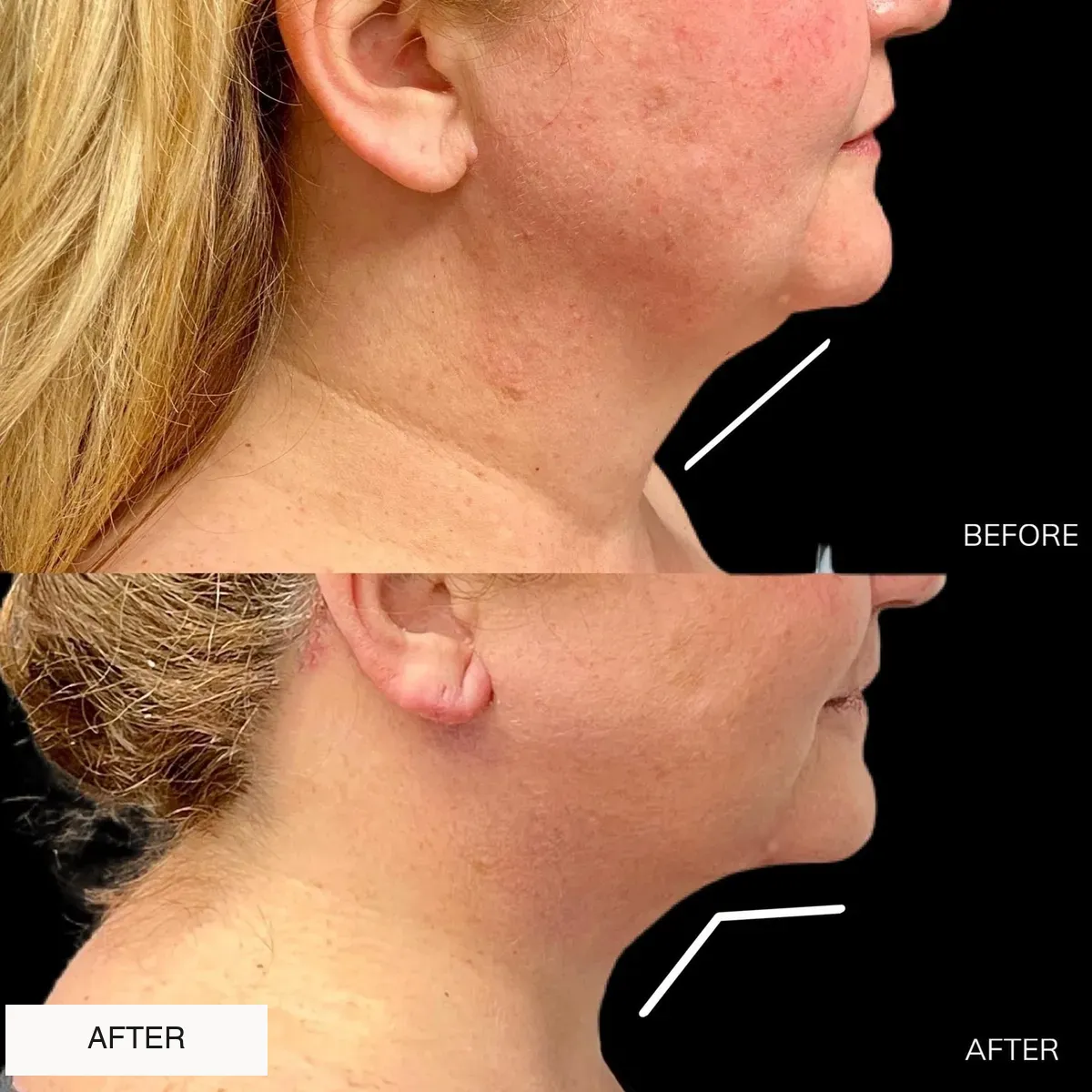 Facelift and neck lift before-and-after comparison.