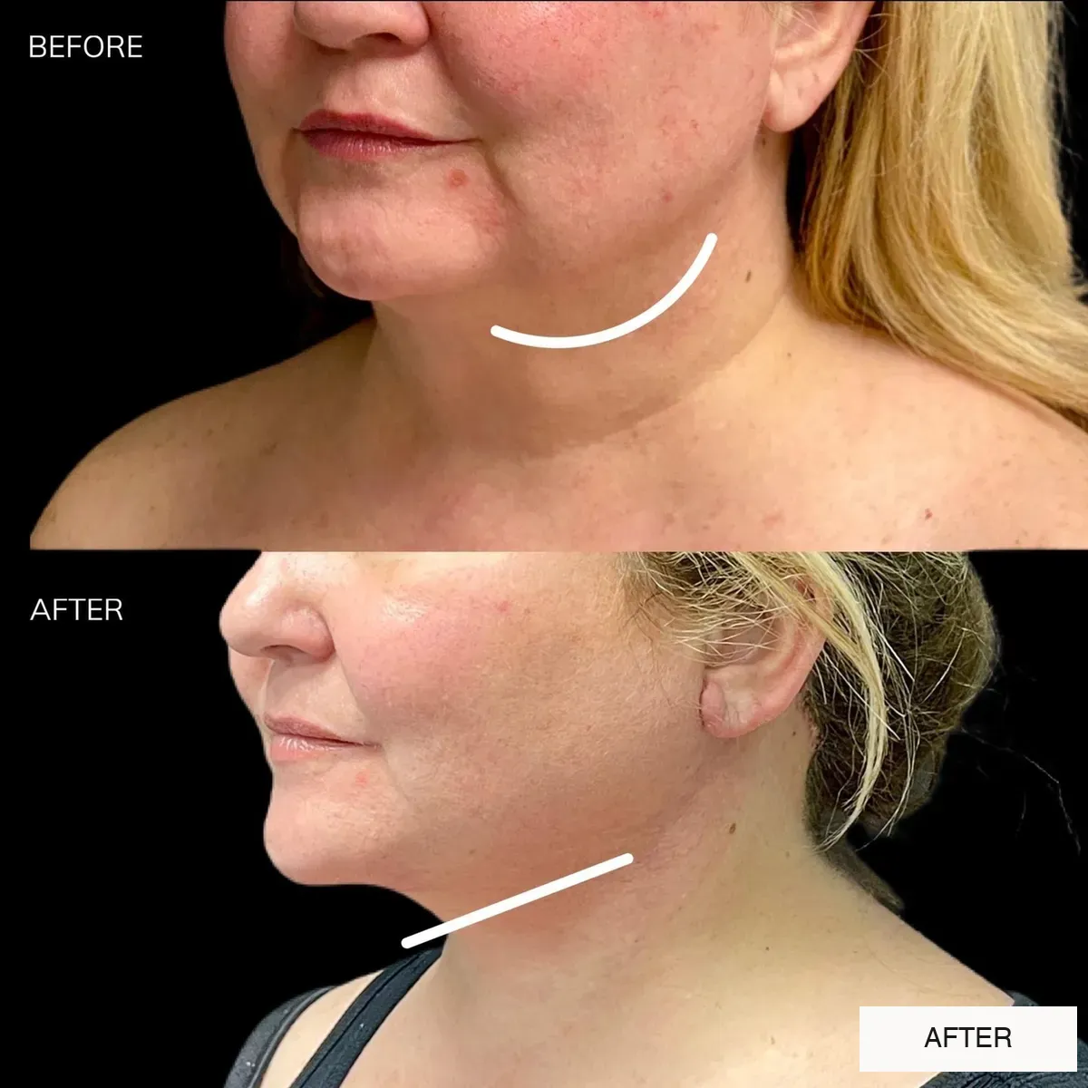 Neck lift before-and-after comparison, two weeks after surgery.