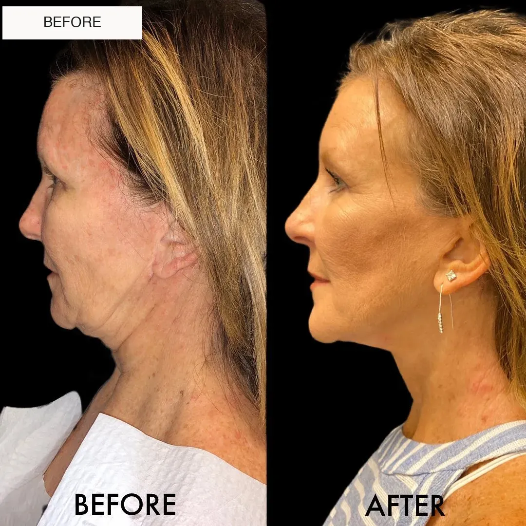 Facelift and neck lift before-and-after comparison.
