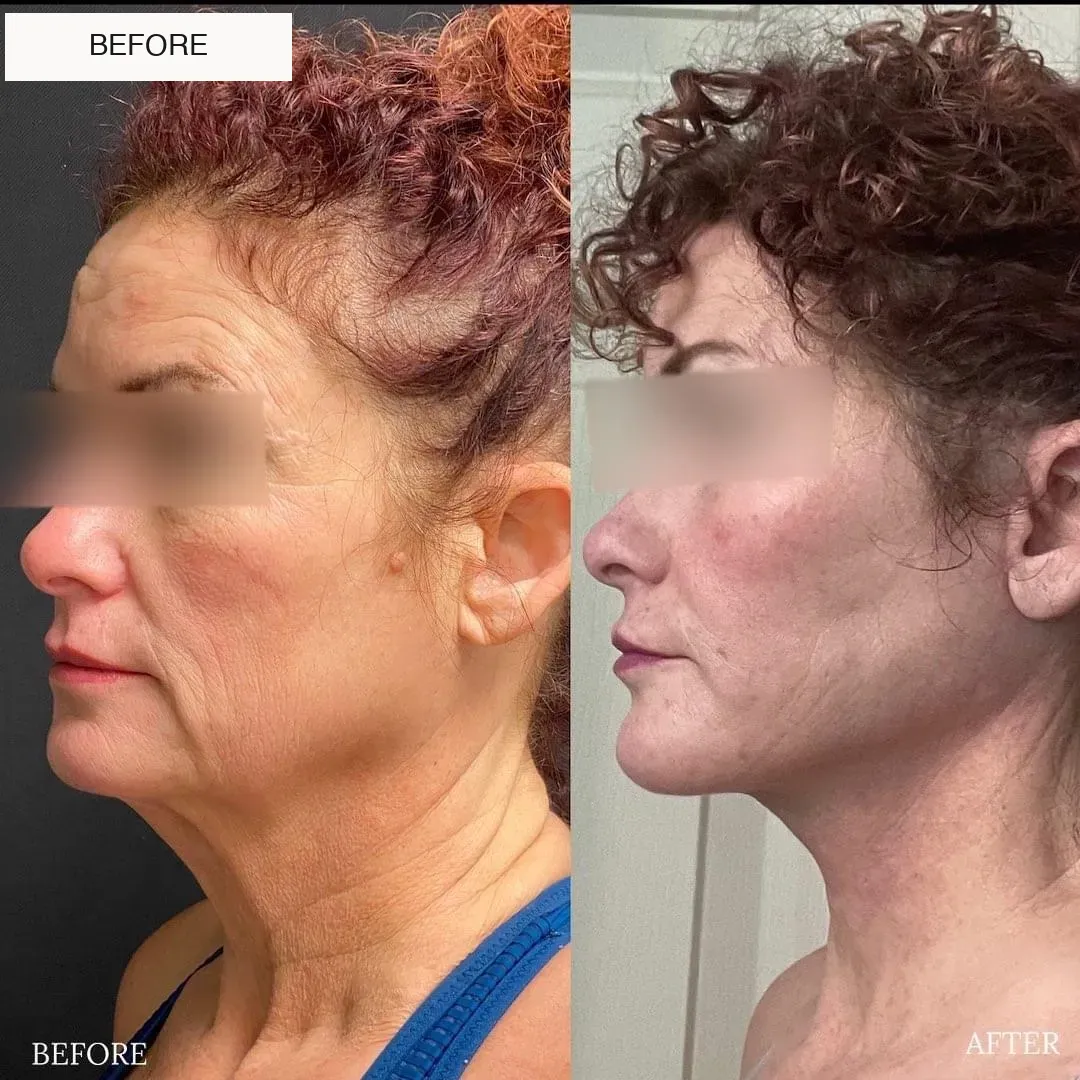 Facelift and neck lift before-and-after comparison.