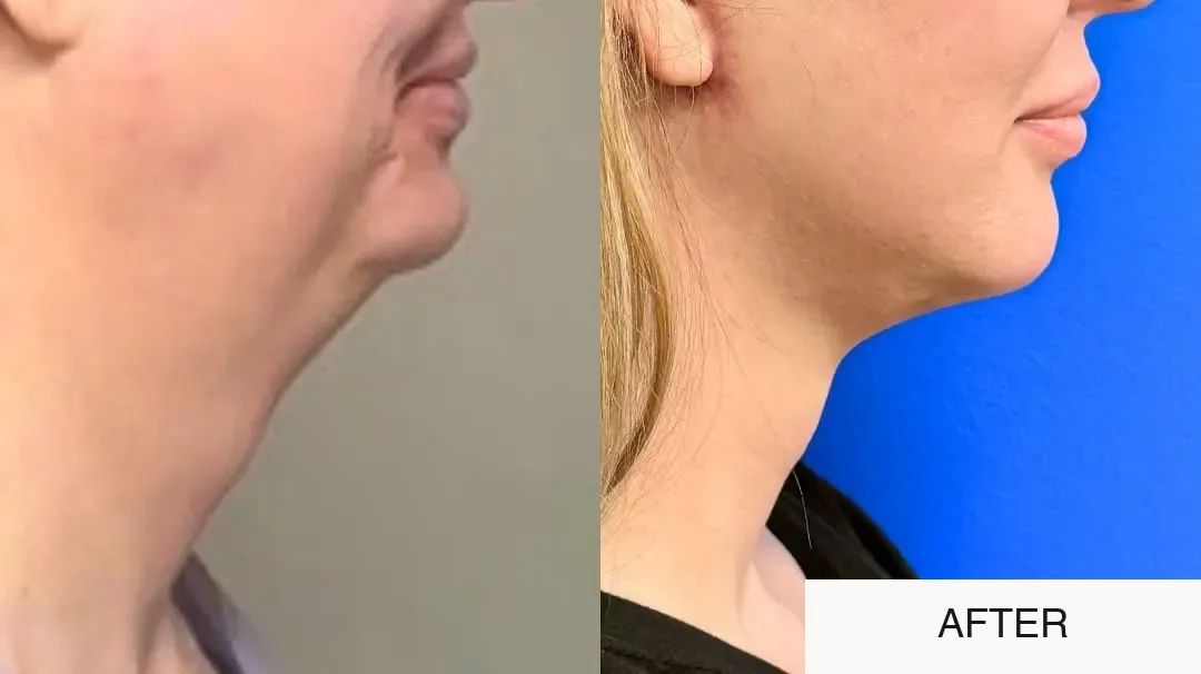 Facelift and neck lift before-and-after comparison.