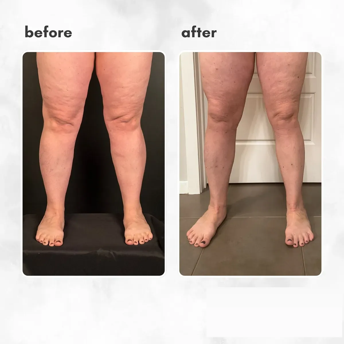 Lipedema before-and-after comparison.