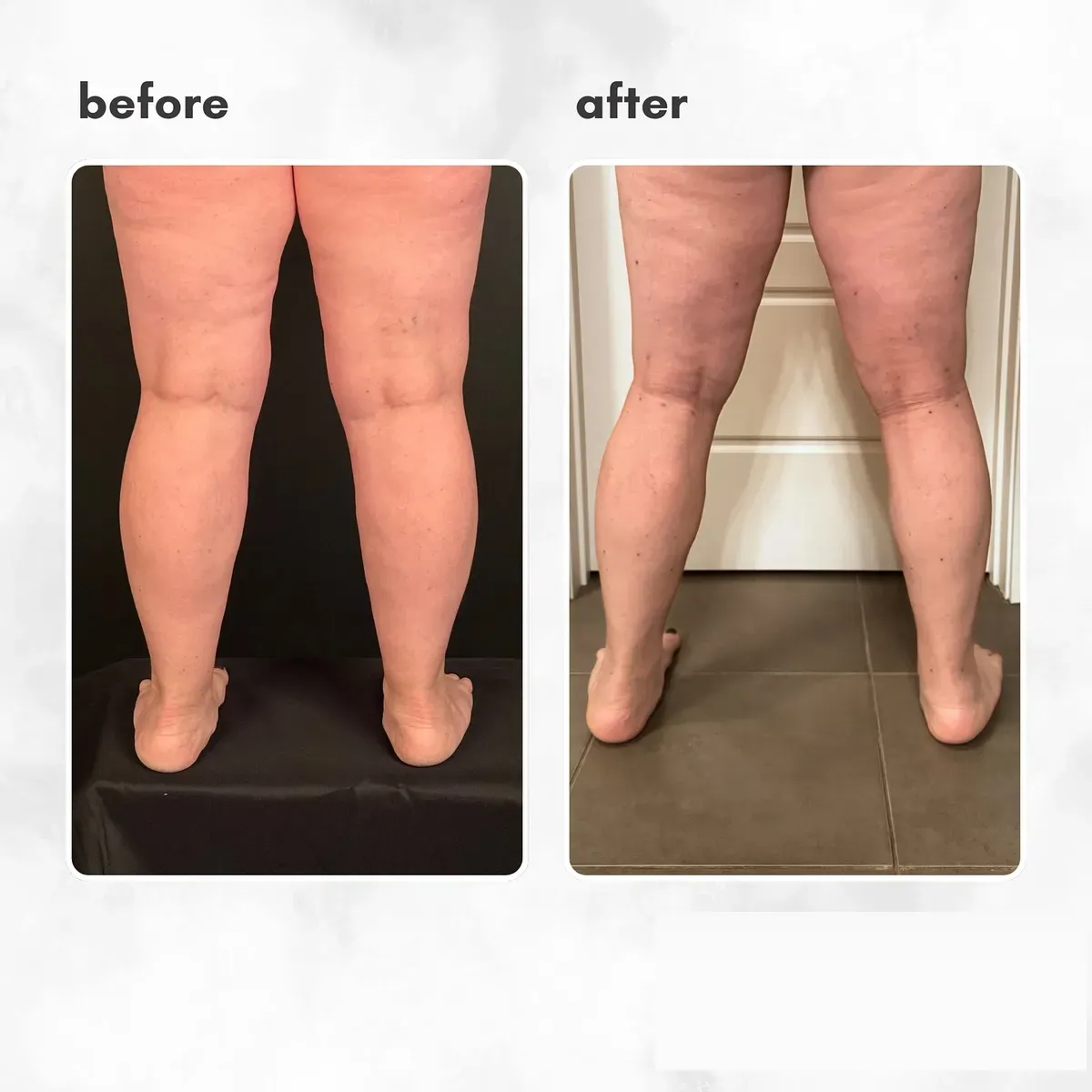 Lipedema before-and-after comparison.