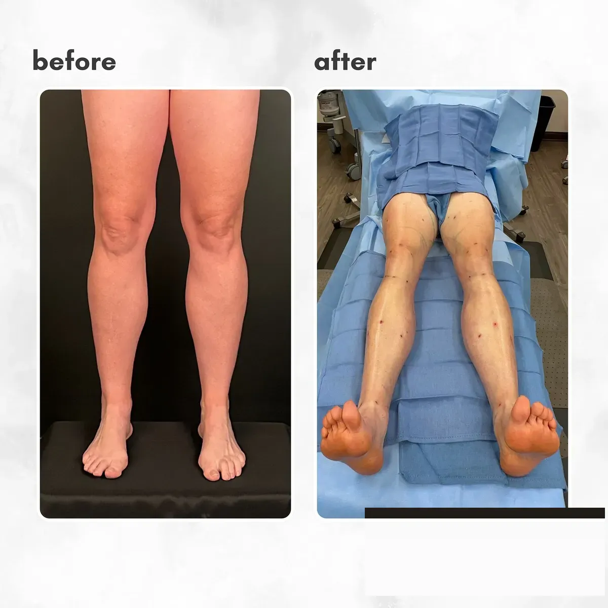 Lipedema before-and-after comparison.
