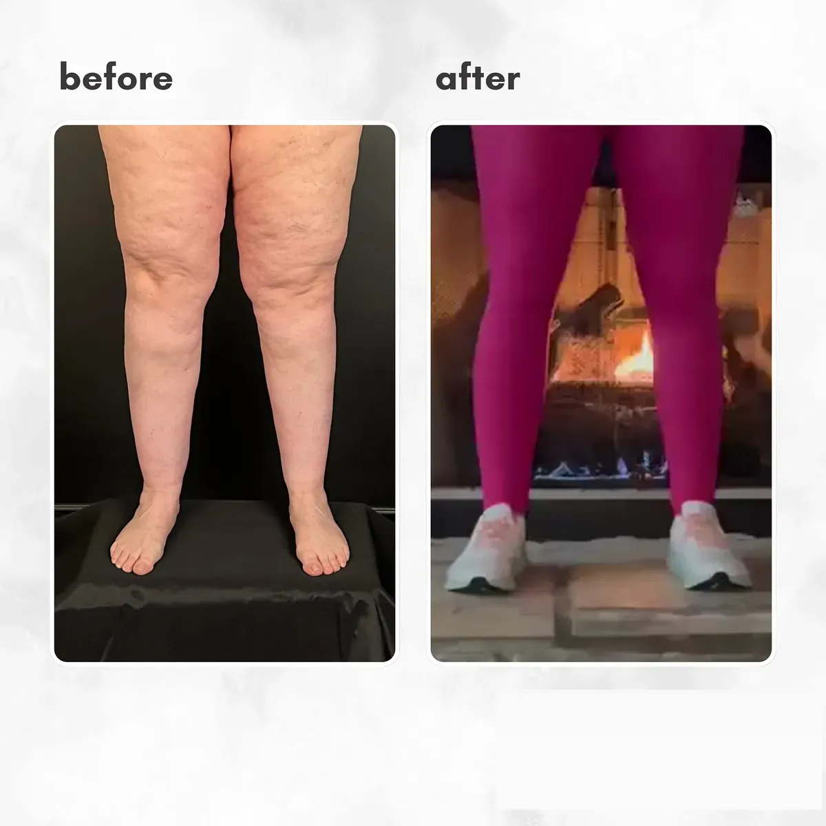 Lipedema before-and-after comparison.