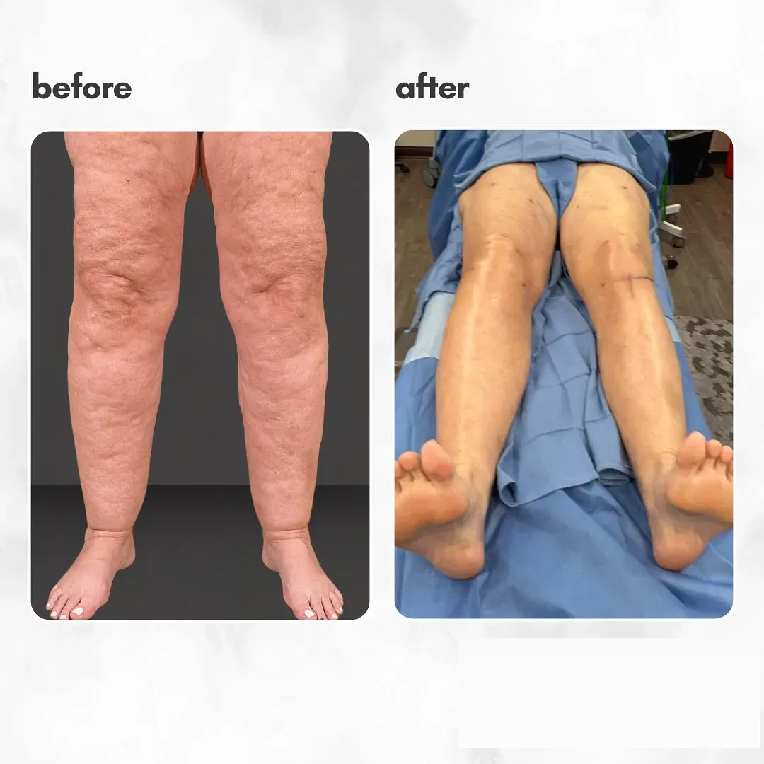 Lipedema before-and-after comparison.
