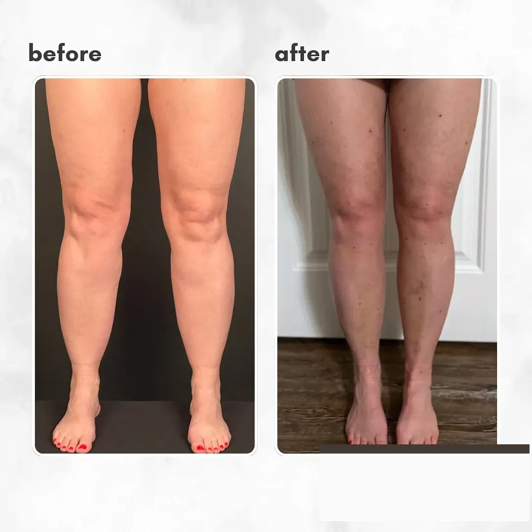 Lipedema before-and-after comparison.