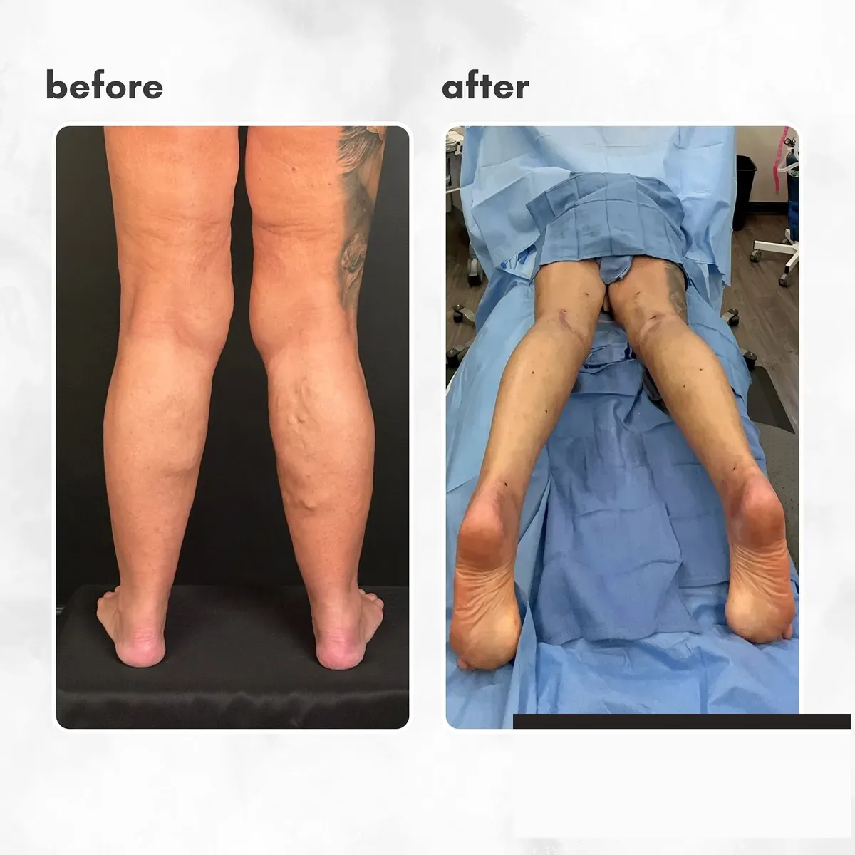 Lipedema before-and-after comparison.